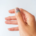 Blå nagel (nagelhematom, subungualt hematom)